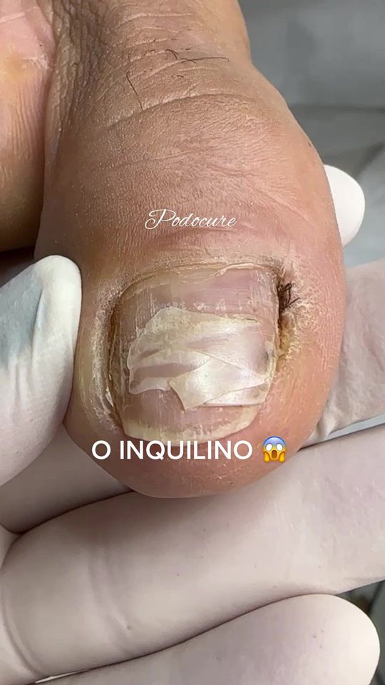 #TikTokMeFezAssistir #ingrowntoenail #satisfying #podocure #