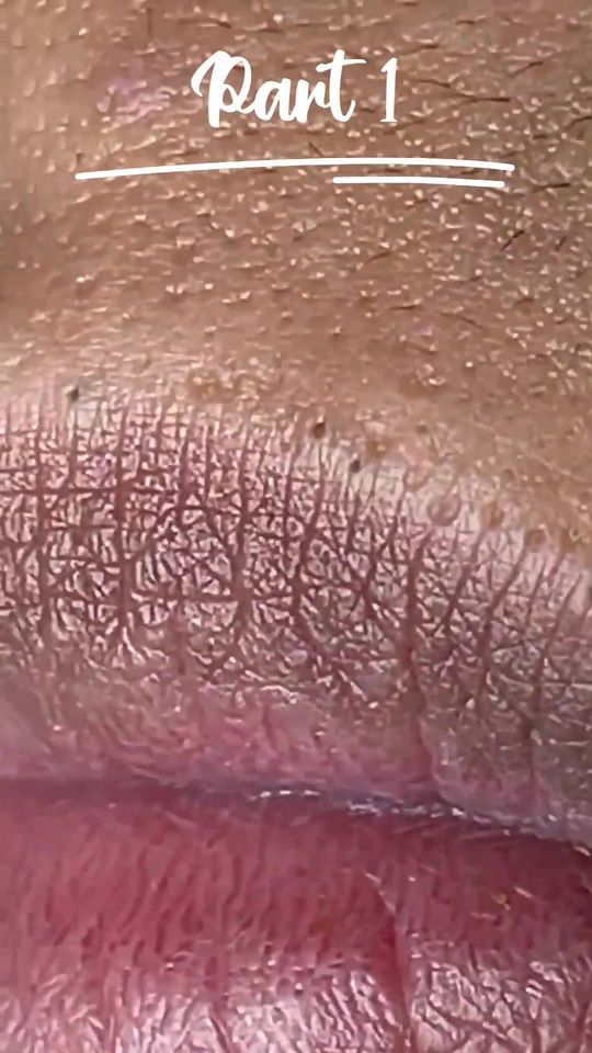 blackheads removal from the lips 💋, #blackheads #satisfying 
