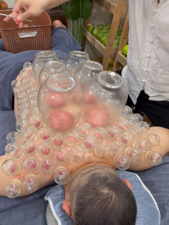 [ASMR] Fire Cupping Therapy #asmr #cuppingtherapy #massage #
