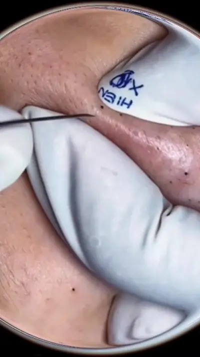 Full clean Blackhead p1#acne #squeeze #squeezeyuk #pimple #blackhead # — @hiepdangodai