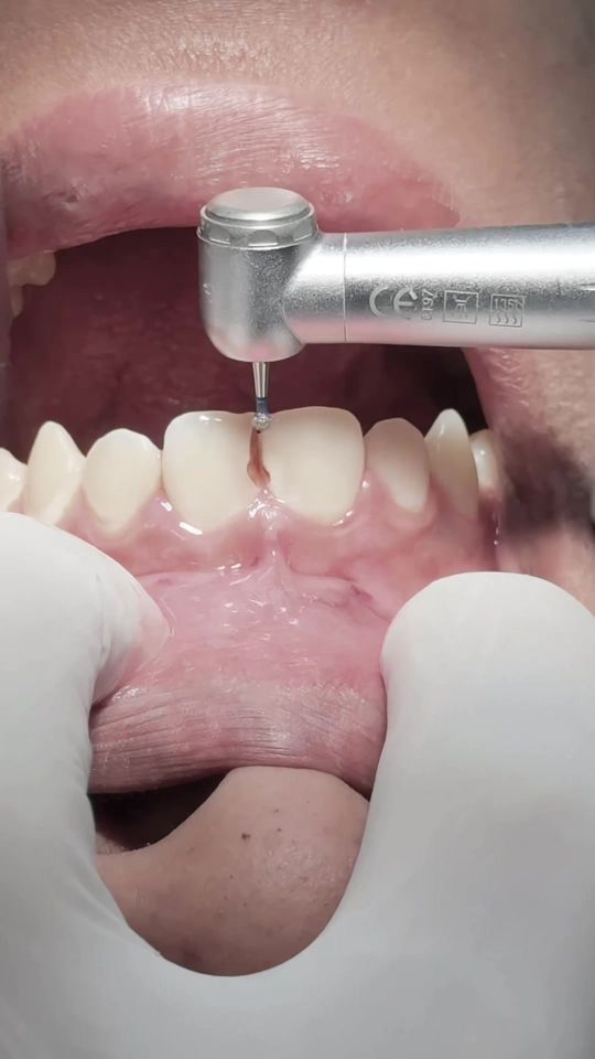 Composite restoration for anterior central incisors teeth wi